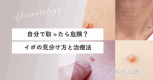 要注意】自分で取ったら危険？イボの見分け方と治療法を皮膚科医が教え