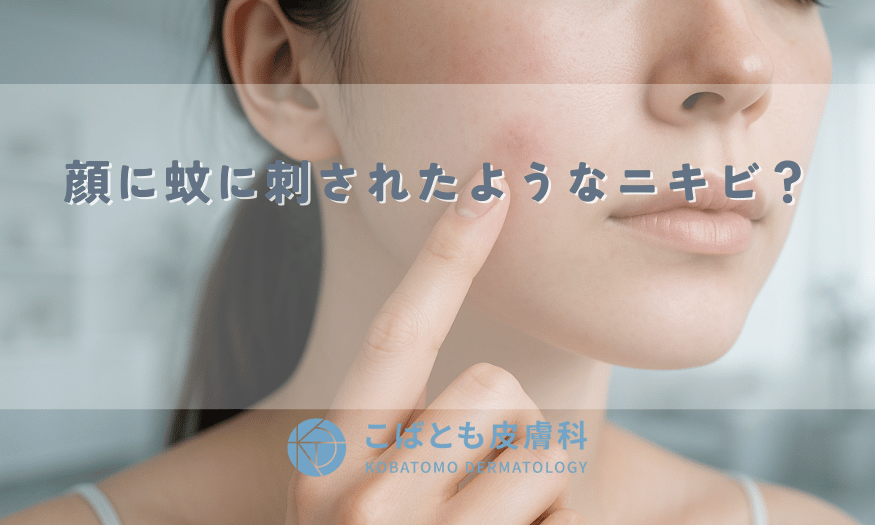 顔に蚊に刺されたようなニキビ？原因と見分け方、正しい治し方を解説