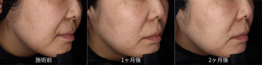 40代女性 BBL × MOXI の症例