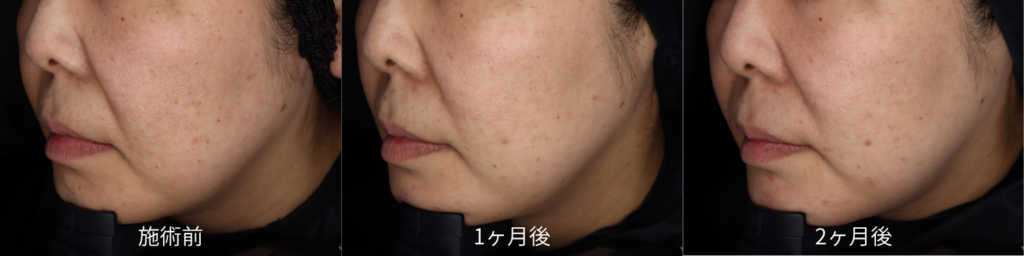 40代女性 BBL × MOXI の症例