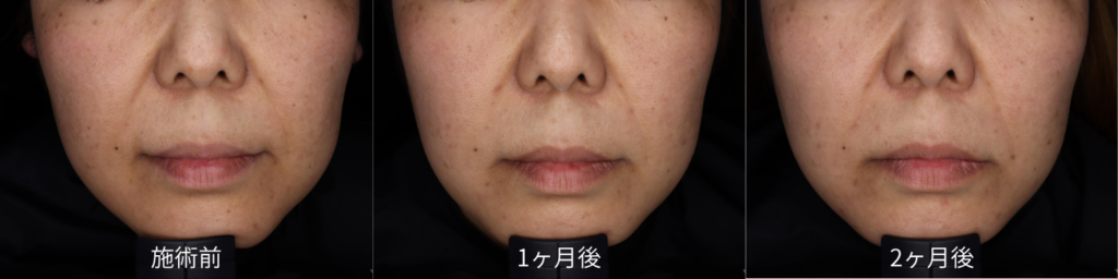 40代女性 BBL × MOXI の症例