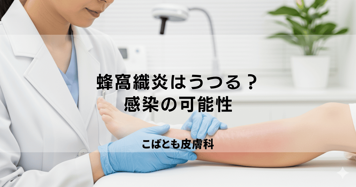 蜂窩織炎（ほうかしきえん）は他の人にうつる？感染の可能性と正しい知識