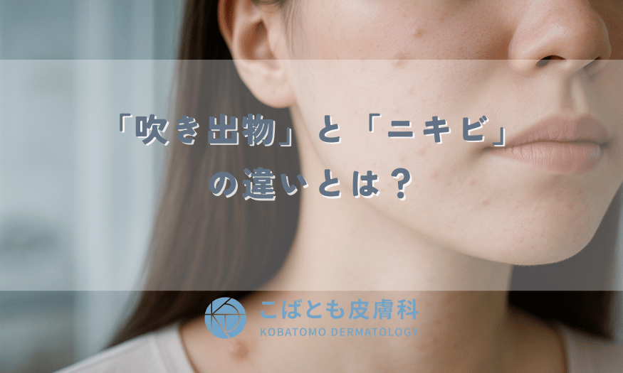 「吹き出物」と「ニキビ」の違いとは？原因、年代別の正しいスキンケア方法