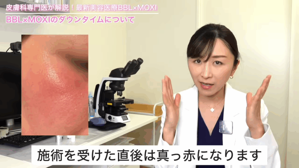 MOXIの施術を受けたあとのお肌