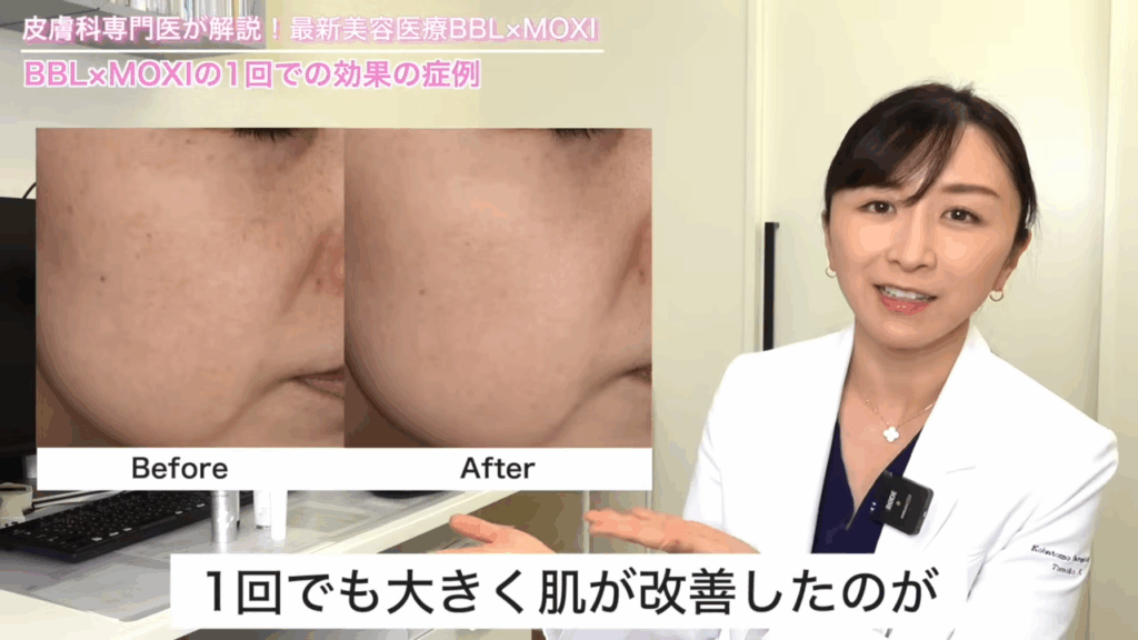 BBL×MOXIの1回での効果の症例