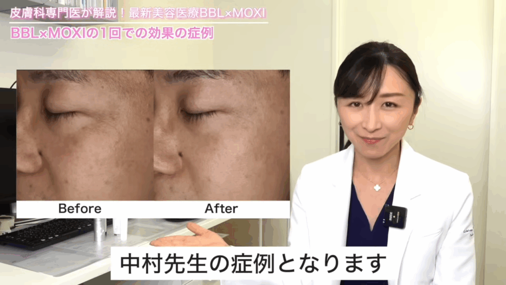BBL×MOXIの1回での効果の症例