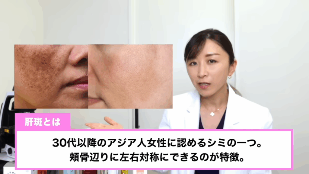 肝斑とは、30代以降のアジア人女性に認めるシミの一つ。頬骨辺りに左右対称にできるのが特徴。