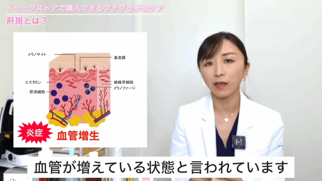 肝斑は真皮というところに炎症が起こっていたり、あとは血管が増えている状態