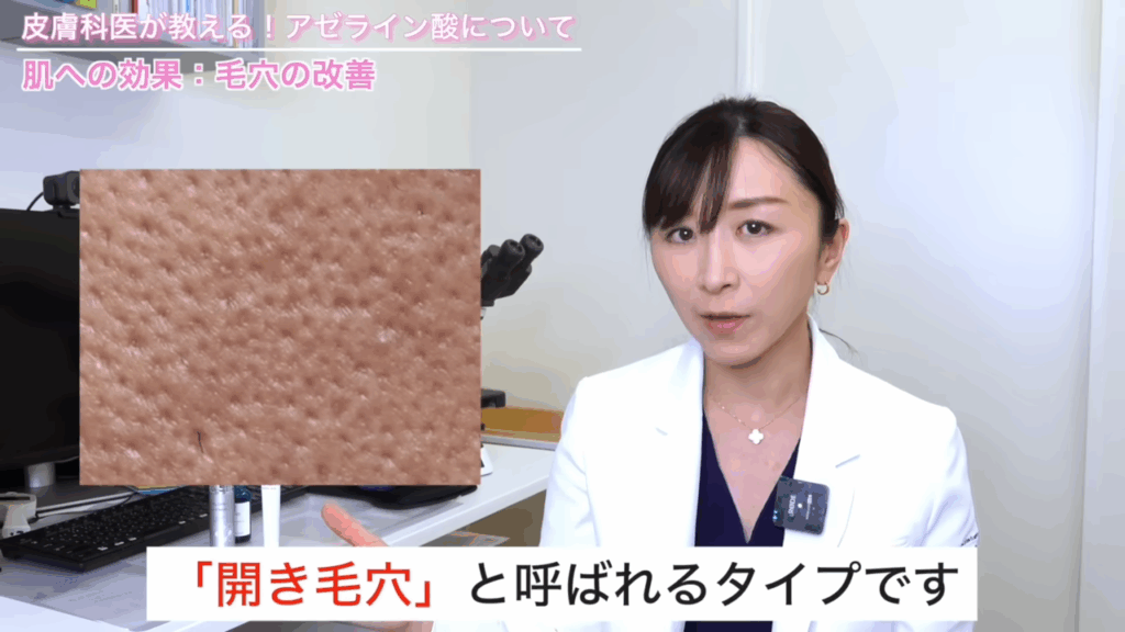 開き毛穴