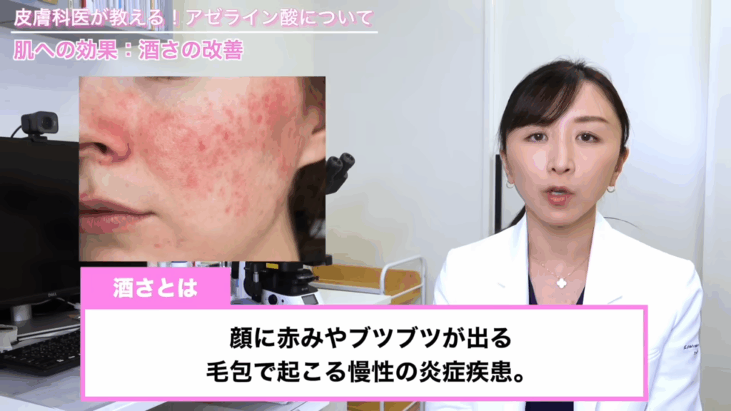 アゼライン酸の効果その４「酒さへの効果」
