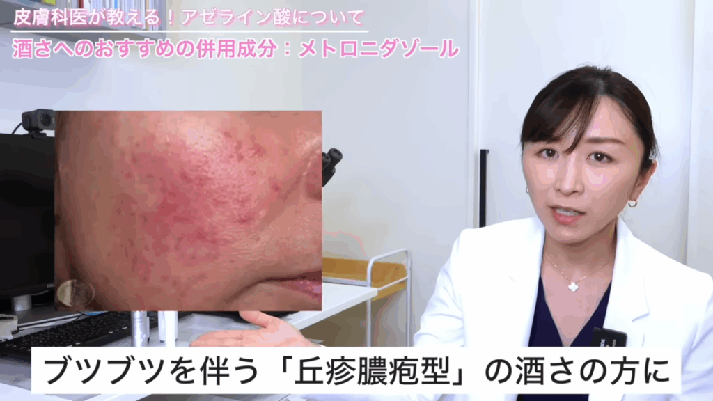ブツブツを伴う丘疹型の酒さ