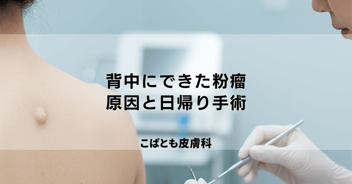 背中にできた「しこり」は粉瘤（ふんりゅう）？原因と日帰り手術について