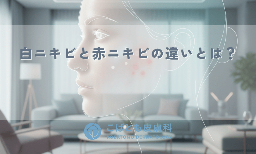 白ニキビと赤ニキビの違いとは？ニキビの段階別・正しい治し方と悪化させないケア