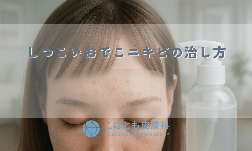 額のブツブツ、原因は前髪のせい？シャンプー？しつこいおでこニキビの治し方