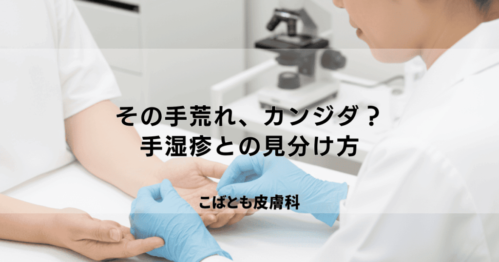その手荒れ、カンジダかも?手湿疹との見分け方と効果的な治療薬