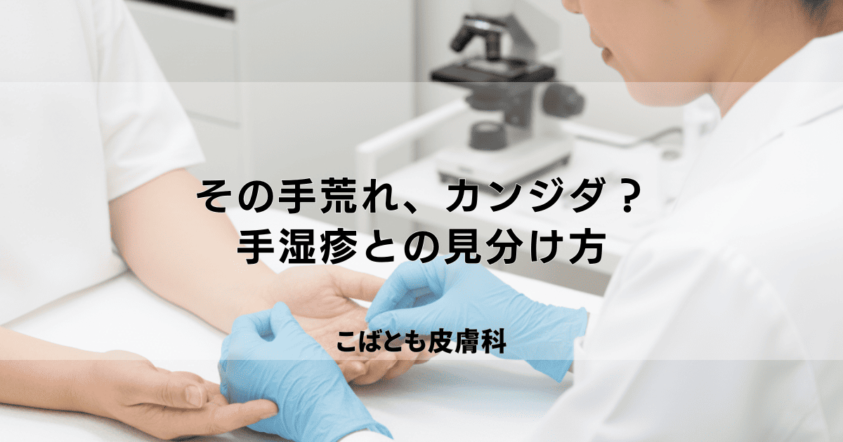その手荒れ、カンジダかも？手湿疹との見分け方と効果的な治療薬