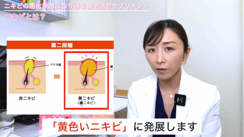 ニキビの第二段階
