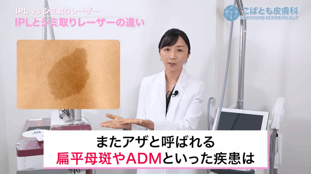 アザと呼ばれる扁平母斑やADMというような疾患は、基本的にレーザー治療1択