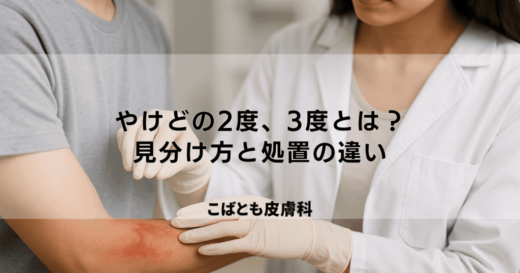 やけどの重症度 2度 3度とは？症状の見分け方と必要な処置の違い