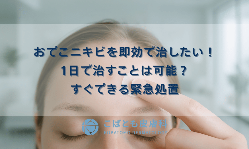 おでこニキビを即効で治したい！1日で治すことは可能？すぐできる緊急処置