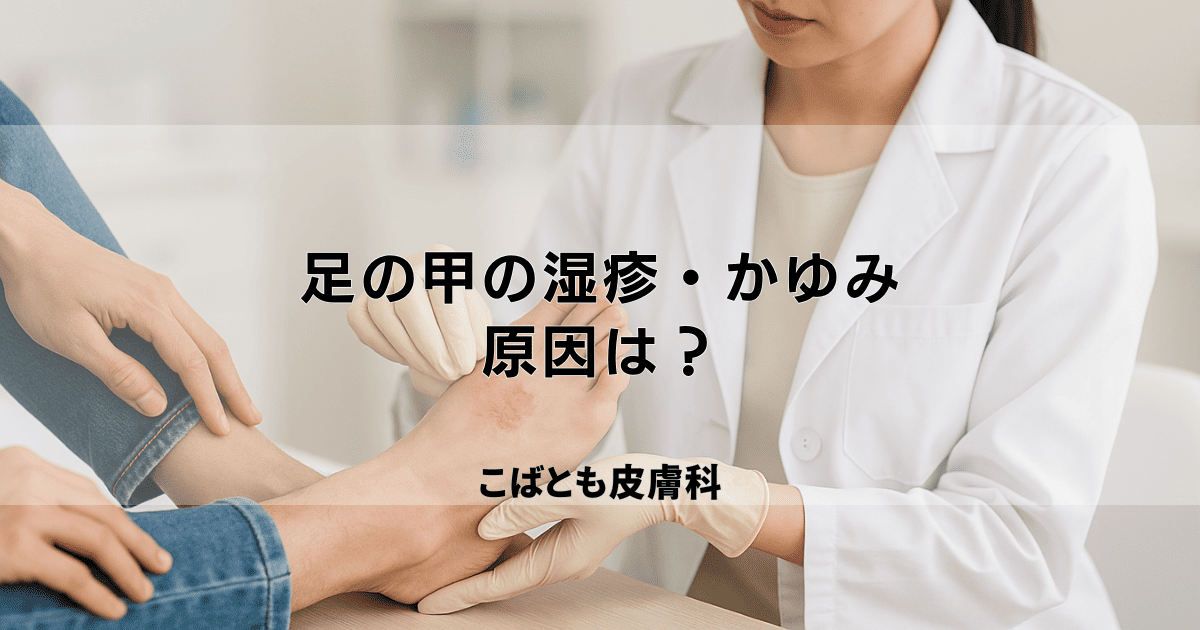 足の甲の湿疹・かゆみの原因は?サンダルのかぶれや靴擦れ、虫刺されかも