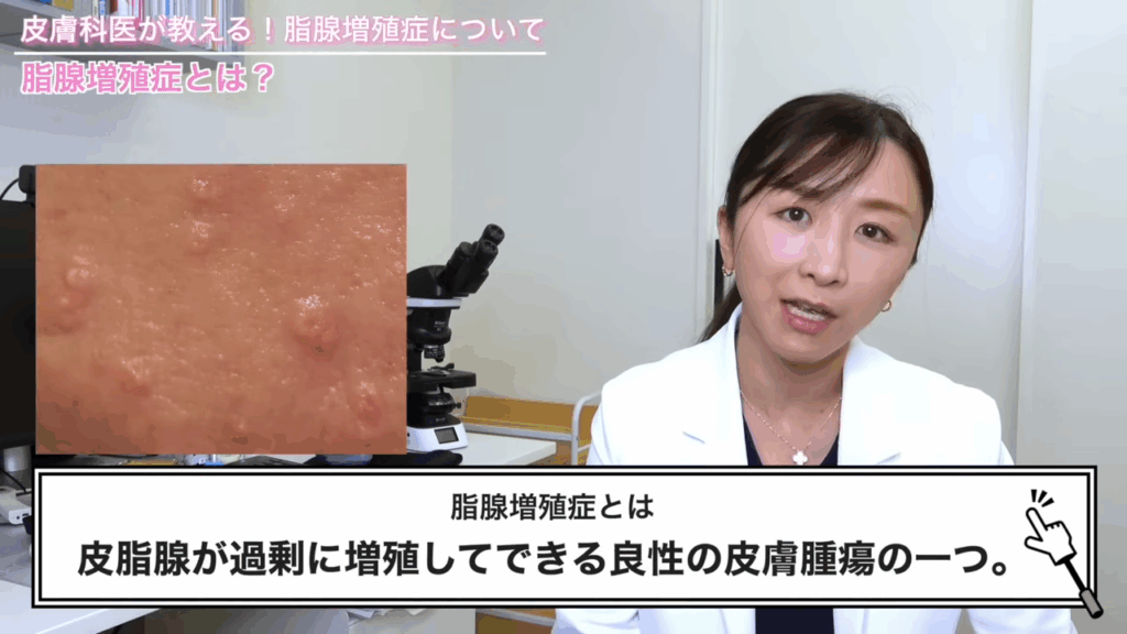 脂腺増殖症とは、皮脂腺が過剰に増殖してできる良性の皮膚腫瘍の一つ