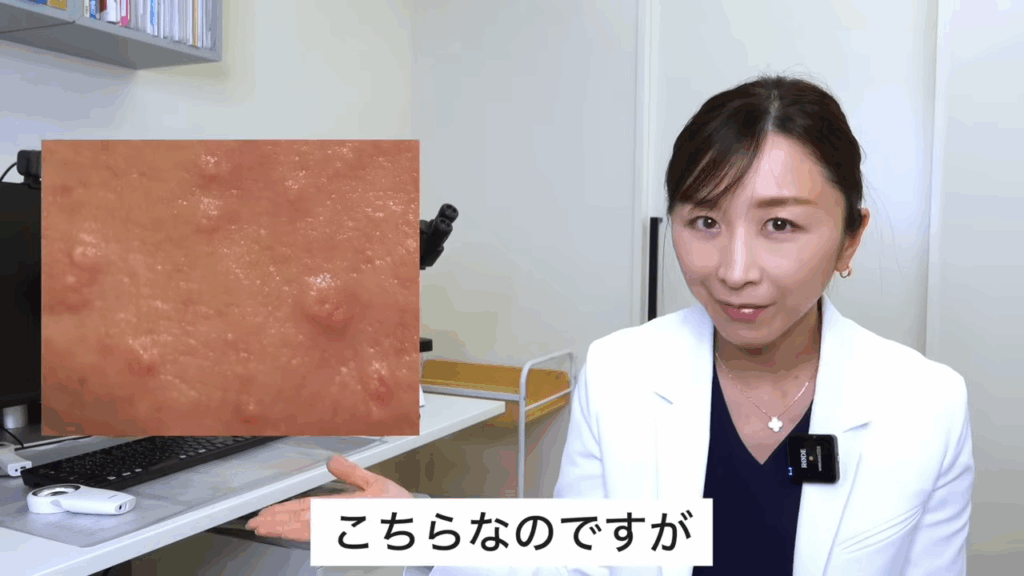 今日お話したいのはこちらのできもの