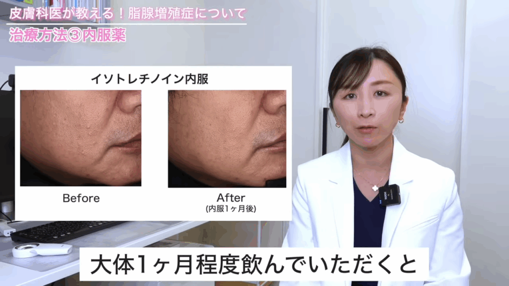 イソトレチノイン 内服1ヶ月後