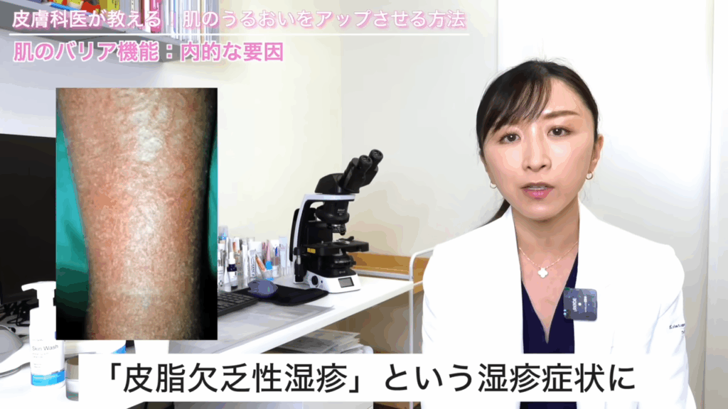 皮脂欠乏生皮膚炎