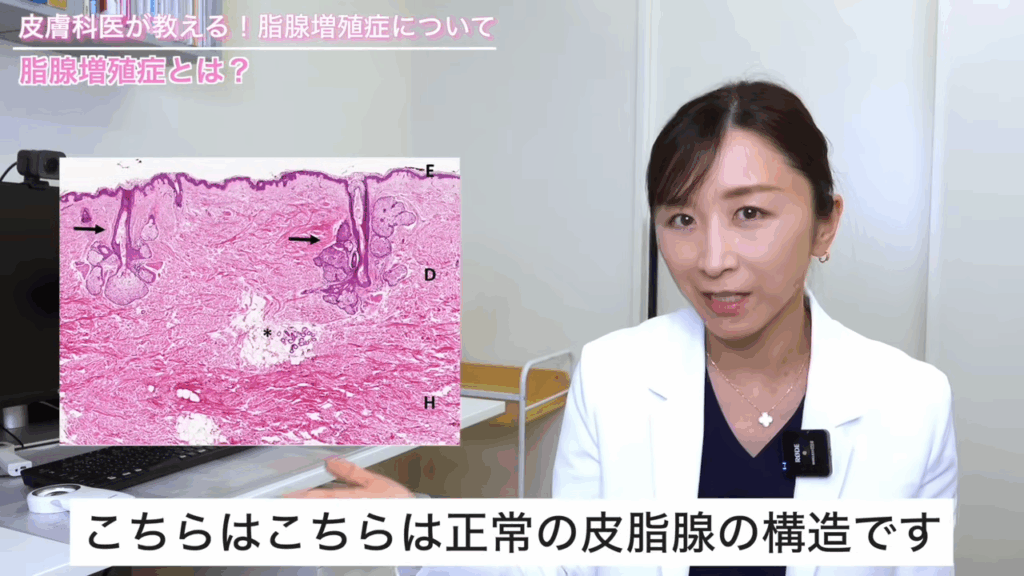 正常の皮脂腺の構造