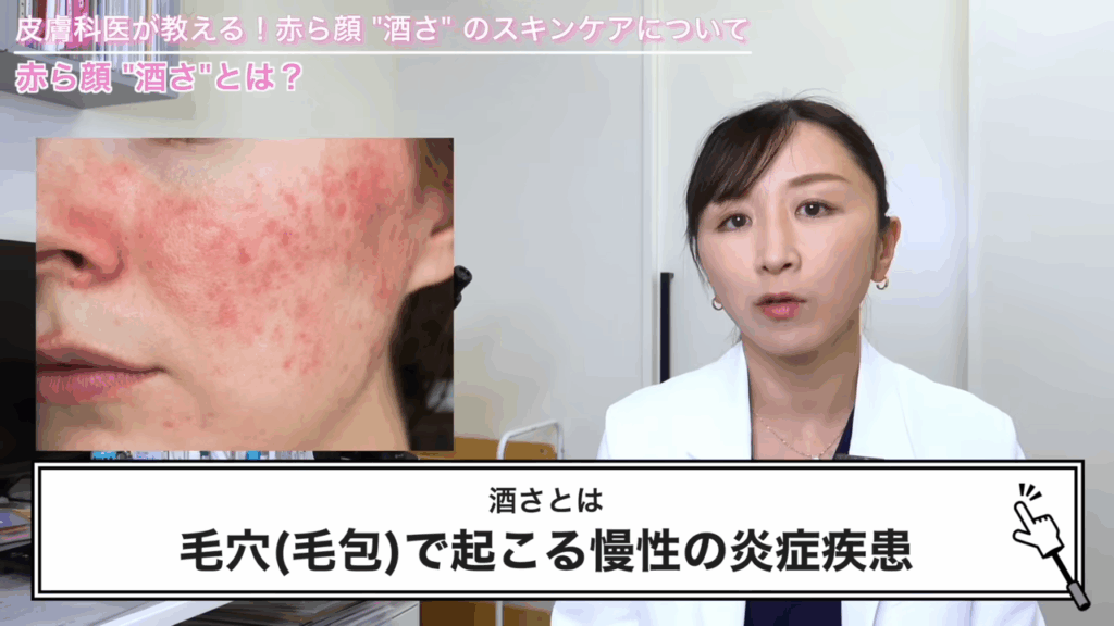 酒さとは、毛穴（毛包）で起こる慢性の炎症疾患