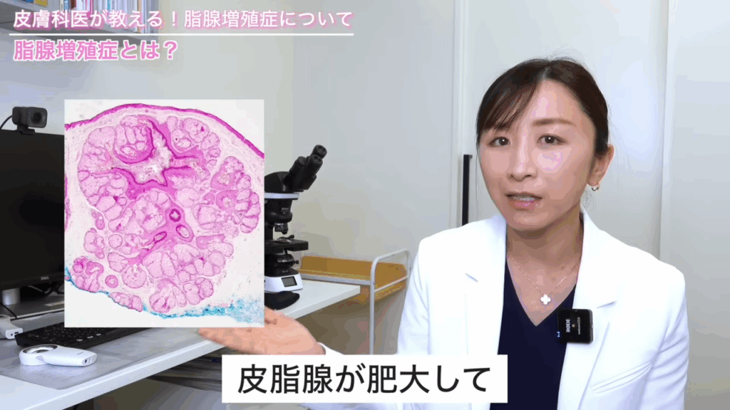 脂腺増殖症では皮脂腺が肥大して大きくなっているのが特徴