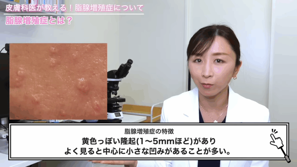 脂腺増殖症の特徴:黄色っぽい隆起(1~5mmほど)があり、よく見ると中心に小さな凹みがあることが多い。