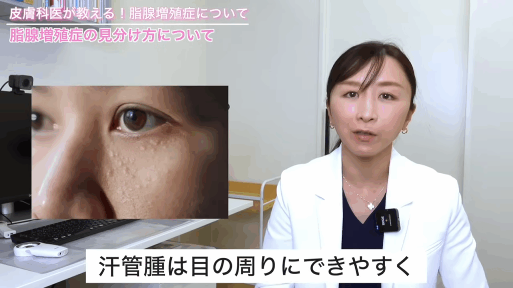 汗管腫は目の周りにできやすいできものの1つ