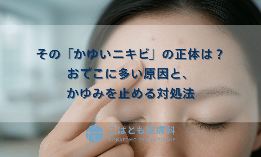 その「かゆいニキビ」の正体は？おでこに多い原因と、かゆみを止める対処法