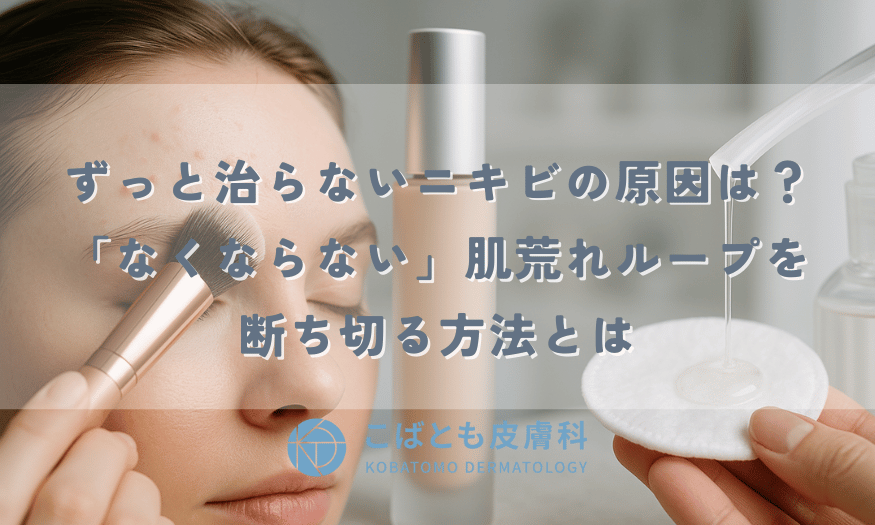 ずっと治らないニキビの原因は？「なくならない」肌荒れループを断ち切る方法とは