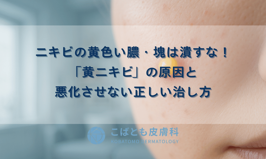 ニキビの黄色い膿・塊は潰すな！「黄ニキビ」の原因と悪化させない正しい治し方