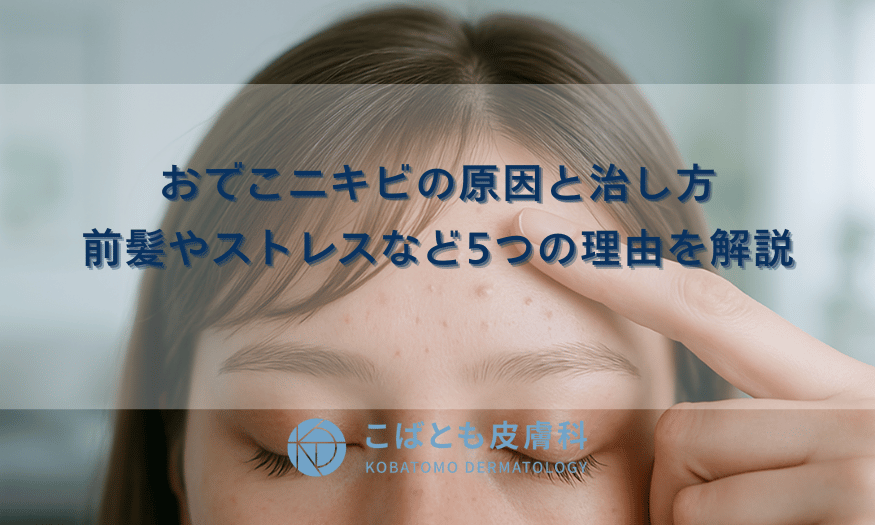 おでこニキビの原因と治し方｜前髪やストレスなど5つの理由を解説
