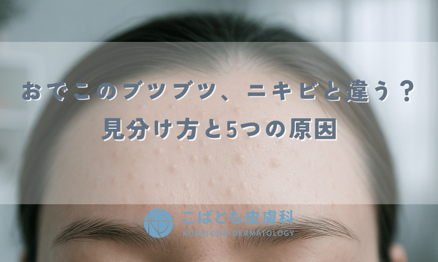 おでこのブツブツ、ニキビと違う？見分け方と5つの原因｜薬が効かない理由