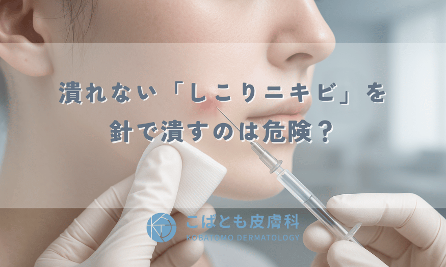 潰れない「しこりニキビ」を針で潰すのは危険？血抜きや芯出しの正しい対処法