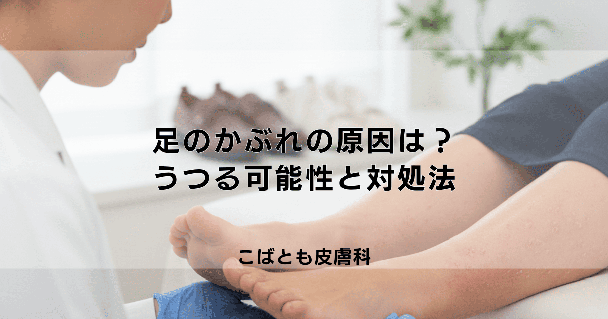 足のかぶれ、その原因は？靴や植物？うつる可能性と正しい対処法