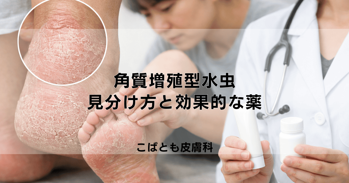 かかとがガサガサになる「角質増殖型水虫」の見分け方と効果的な薬