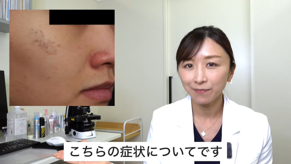 シミに見えやすいが、これはADM（後天性真皮メラノサイトーシス）というアザの一種です