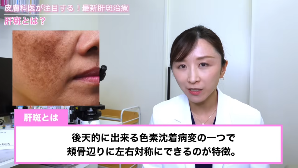 肝斑とは、後天的にできる色素沈着病変の一つで頬骨辺りに左右対称にできるのが特徴