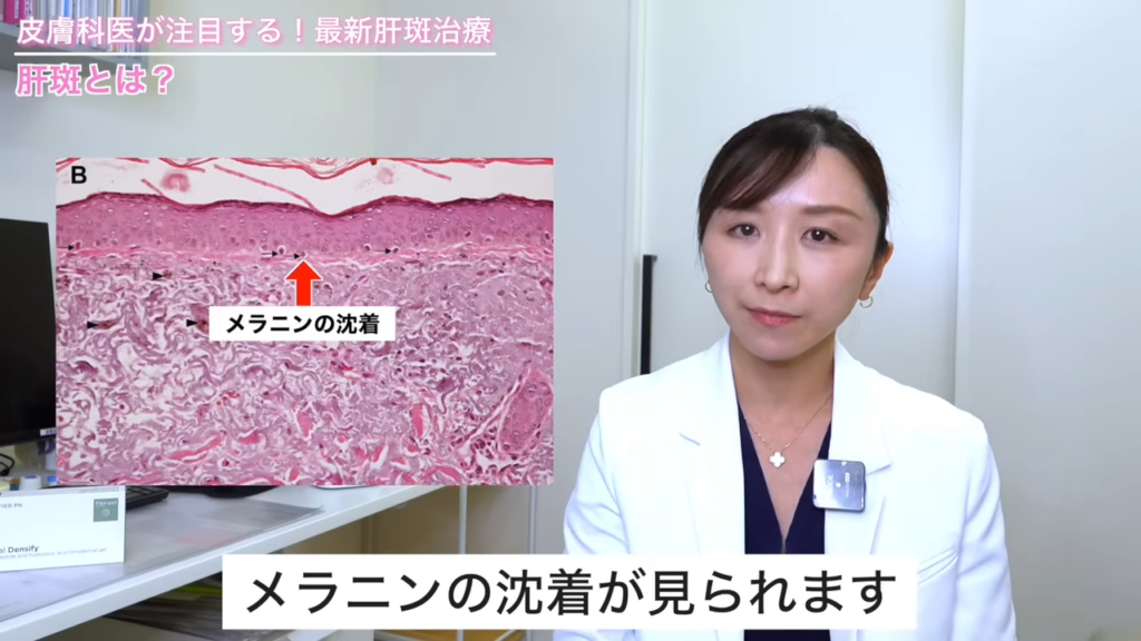 肝斑の場合、皮膚の表面にある表皮というところの基底層でメラニンの沈着が見られます。