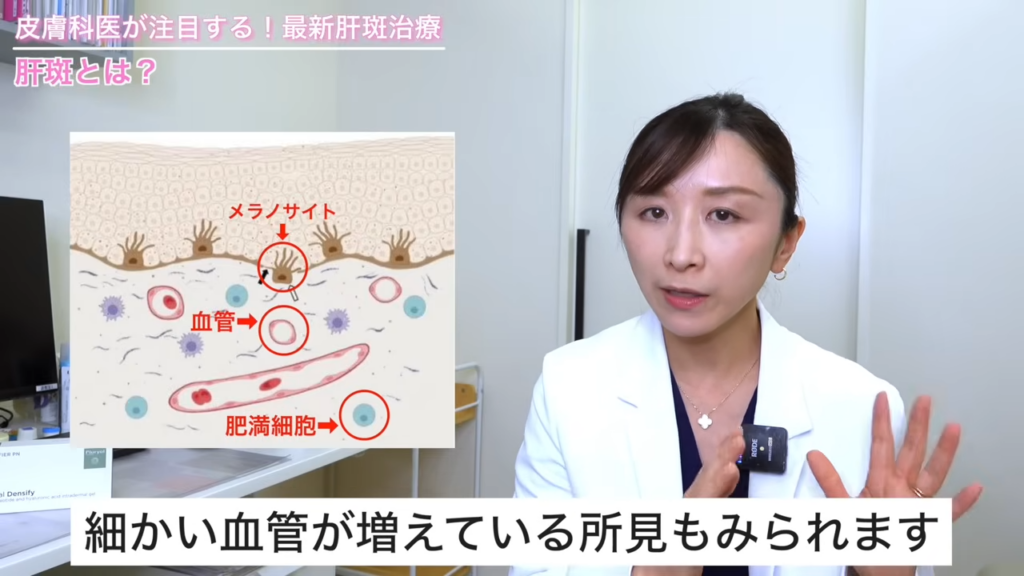 肝斑では肥満細胞と呼ばれるような炎症細胞が増えていたり、それによって血管増生と言って細かい血管が増えている所見も見られます。