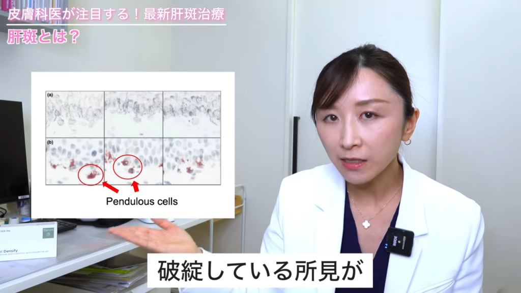 肝斑では基底膜と呼ばれる表皮と真皮の境目のところが破綻しているのが肝斑の患者さんにおいては見られます。