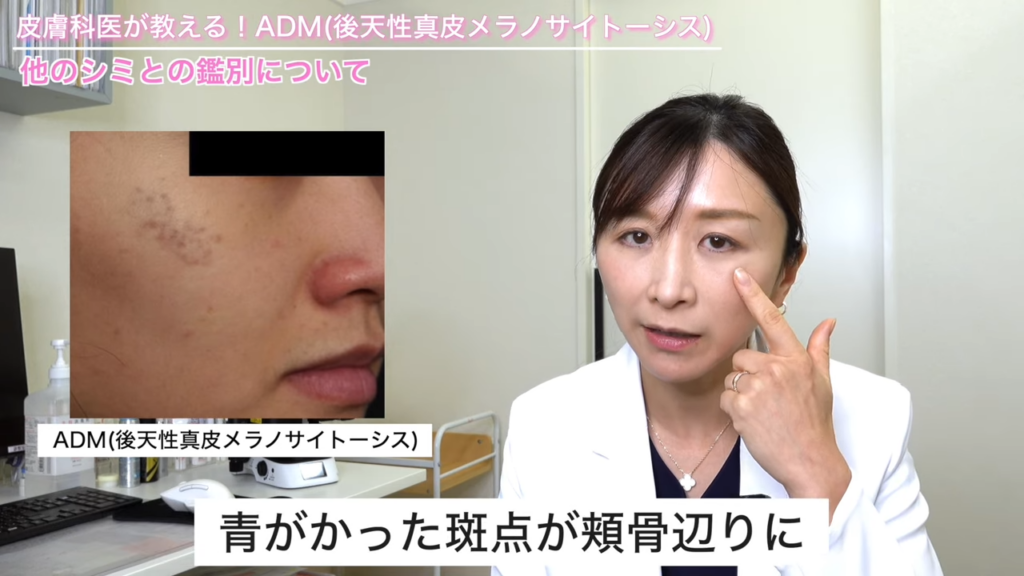 ADM（後天性真皮メラノサイトーシス）