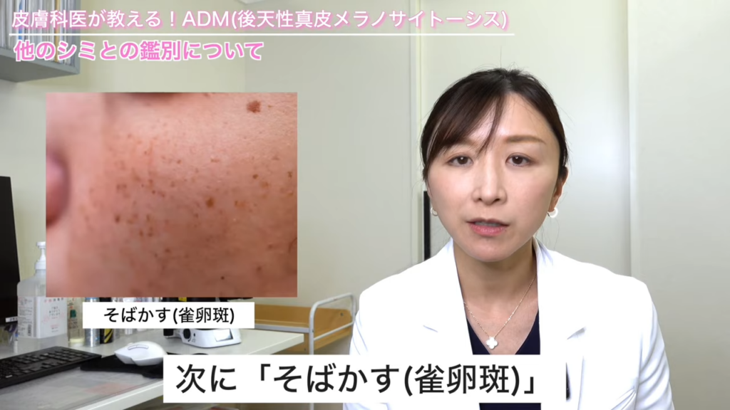 そばかす（雀卵斑）