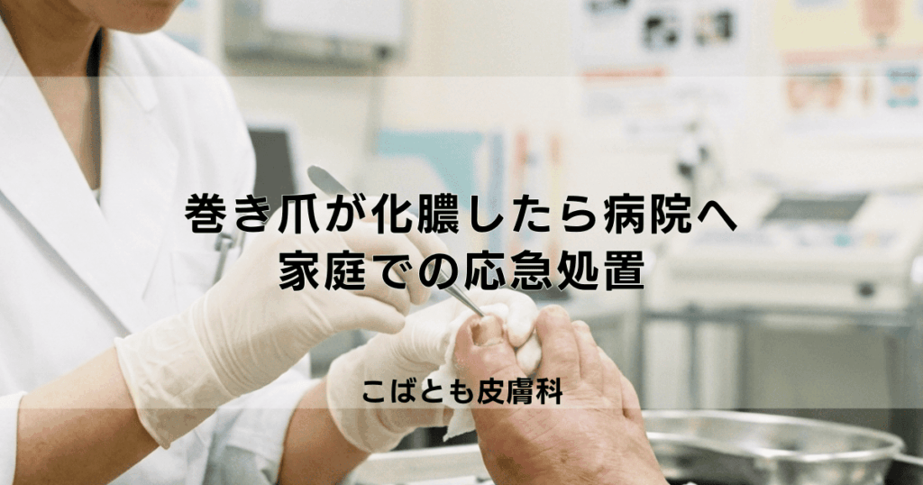 巻き爪が化膿して膿が出たらすぐに病院へ！家庭での応急処置と治療法
